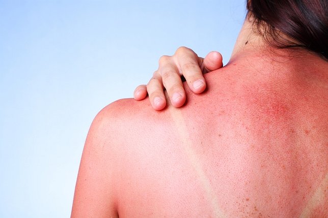 How to Avoid getting and Treat Sunburn this Summer | LongIsland.com